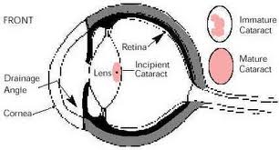 Cataracts